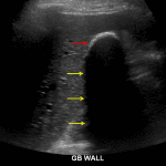 Thickened, echogenic gallbladder wall (red arrow) with sharp posterior acoustic shadowing (yellow arrows), which is a typical imaging appearance for porcelain gallbladder.