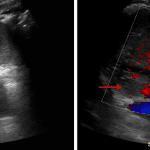 Possible area of hypoechogenicity in the upper pole of the right kidney without discernible internal vascularity (red arrows), which may represent phlegmon or developing abscess in the setting of pyelonephritis.
