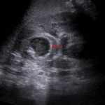 Hypoechoic lesion in the left kidney with an echogenic rim (red arrow), concerning for abscess.