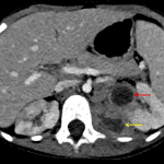 Due to clinical worsening, a CT was performed several days later which showed enlargement of the renal abscess (red arrow) and abscess extension into the posterior perinephric fat and musculature (yellow arrow). The patient went on to percutaneous drainage.