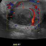 Hypoechoic mass in the right testicle without definite internal vascularity (red arrows), which was proven on pathology to represent a segmental testicular infarct.