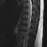 Serpiginous, mildly prominent vessels along the dorsal surface of the lower thoracic spinal cord (red arrows), concerning for an arteriovenous fistula.