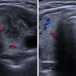Ill-defined hypoechoic nodule in the left thyroid lobe with decreased internal vascularity (red arrows), which although not entirely specific is typical for subacute thyroiditis.