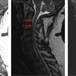 Ventral epidural collection spanning the levels of C1-C3 which appears hyperintense on both T1 (image to the left) and T2 (image in the middle) weighted sequences and does not demonstrate signal suppression on STIR (image to the right), consistent with an epidural hematoma.