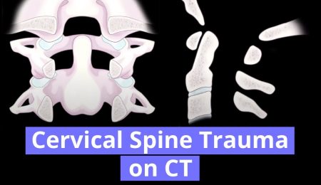 Cervical Spine Trauma