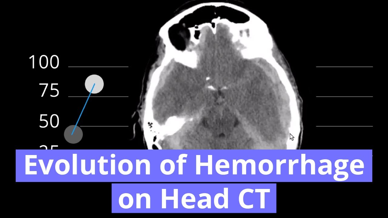 Evolution of Hemorrhage on Head CT