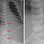 The umbilical arterial catheter, which is difficult to see on this image, ascends to the level of T9 where it then appears to loop back on itself (red arrows).