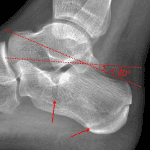 Lateral ankle radiograph in this patient with Bohler's angle measuring less than 20 degrees. The fracture involving the posterior and mid aspects of the calcaneus is identified by the red arrows.