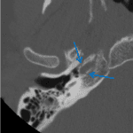 Fracture of the right temporal bone (red arrows) with involvement of the right foramen ovale and spinosum (not well seen, but in the area of the yellow arrow), the right carotid canal (blue arrows), and the right foramen rotundum and lateral wall of the right sphenoid sinus (green arrows).
