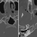 Fracture involvement of the right orbital roof (red arrow) extending inferiorly into the right superior orbital fissure, fracture of the right zygomatic arch (yellow arrow), fracture of the left lateral pterygoid process (blue arrow), and fracture of the right hemimandible (green arrow).