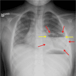 Rounded density in the lower left lung (red arrows) containing an air-fluid level (yellow arrows), which is concerning for an abscess.