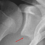 Tiny ossific density inferior to the glenoid