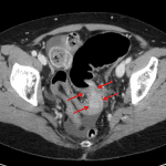 A subsequent contrast-enhanced CT on this patient demonstrates an obstructing sigmoid colonic mass (red arrows) concerning for malignancy.