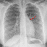 In this case, pneumomediastinum is most apparent along the upper left heart border on the PA view (red arrow).