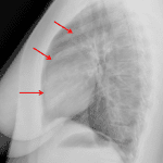 In this case, pneumomediastinum is most apparent along the anterior heart border on the lateral view (red arrows).