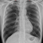 Note symmetric bilateral linear lucencies tracking into the neck (red arrows), which can be seen with superior migration of pneumomediastinum.