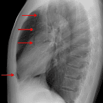 Pneumomediastinum is often more apparent on the lateral view, and in this case results in lucency outlining the anterior margins of the heart and mediastinal vasculature (red arrows).