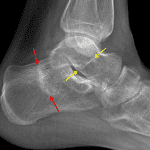 Red arrows: calcaneal stress fracture. Yellow arrows: possible additional stress fracture involving the talar neck.
