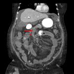 SMV thrombosis (red arrows) with associated mesenteric venous engorgement, mesenteric edema, and mural thickening of multiple loops of jejunum.