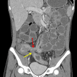 Inflammatory changes of the terminal ileum and sigmoid colon with enteroenteric (red arrow) and enterocolonic (yellow arrow) fistulas.