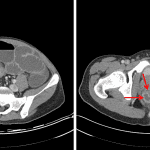 Pericecal (yellow arrow) and perirectal (red arrows) abscesses.