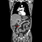 Large, peripherally-calcified gallstone in the mid small bowel (red arrow) with associated upstream small bowel distension and inflammatory changes.