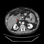 Inflammatory changes of the gallbladder with a visible fistulous tract between the gallbladder and duodenum (red arrow).