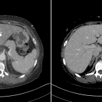 Intense enhancement in hepatic segment 4 (red arrow) on the arterial phase image on the left, with no residual enhancement above liver on the delayed phase image on the right, consistent with the hot quadrate sign of SVC occlusion.