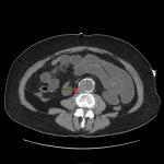 Discontinuous mural calcification with a focal outpouching along the right posterior wall of an abdominal aortic aneurysm (red arrow), which places the patient at increased risk for future rupture.