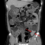 Large bowel obstruction due to a mass at the junction of the descending and sigmoid colon (red arrows).