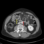 Adjacent areas of mesenteric swirling in the central small bowel mesentery (red arrow) and in the right hemiabdomen just upstream from the enteroenteric anastomosis (yellow arrow).