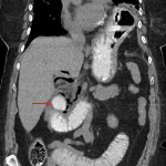 Duodenal diverticulum filled with oral contrast material (red arrow) with adjacent extraluminal gas tracking into the porta hepatis.