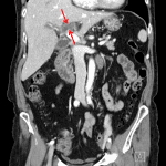 Left portal vein thrombosis with wall thickening and enhancement (red arrows), suspicious for pylephlebitis.