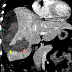 Hepatic parenchymal hematoma (red arrow) communicating (yellow arrow) with a large subcapsular hematoma (blue arrow).