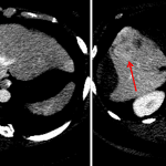 Ill-defined enhancing lesions in the right hepatic lobe (red arrows), including along the margins of the parenchymal hematoma, concerning for hepatic adenomas with associated rupture.