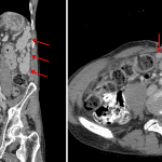 Multiple intraabdominal nodules with similar imaging characteristics, most concentrated in the left upper quadrant (red arrows), which are consistent with splenosis in this patient with history of splenectomy.