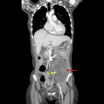 Enlarged, hypoenhancing left lower quadrant transplant kidney (red arrow) with visualization of the transplant artery (yellow arrow) but not the transplant vein in the renal hilum.