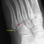 Nondisplaced distal cuboid fracture with a tiny fracture fragment in the fifth TMT joint (red arrow). Incidental os vesalianum pedis (yellow arrow).