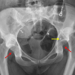 Bilateral posterior hip dislocations with the femoral heads projecting superior to their respective acetabula. Irregularity of the posterior acetabular walls (red arrows) likely representing acute fractures. Sclerotic lesion in the left acetabular roof (yellow arrow), which is likely an incidental bone island.