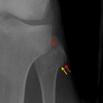 Subtle nondisplaced fibular head fracture (red arrows) with corresponding cortical impaction (yellow arrow).