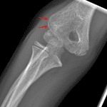 Acute minimally displaced lateral condylar fracture (red arrows).