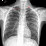 Pneumomediastinum tracking into the neck (red arrows).