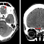 Subtle intraparenchymal hematoma in the inferior left frontal lobe with surrounding edema (red arrows).