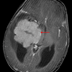 Avidly enhancing mass centered in the temporal horn of the right lateral ventricle (red arrow), consistent with a choroid plexus tumor.