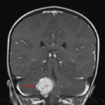 Avidly enhancing mass centered in the right foramen of Luschka (red arrow), consistent with a choroid plexus tumor.