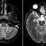 Numerous subpial cysts coating the brainstem, cerebellum, and inferior aspects of the supratentorial structures, which is a characteristic imaging appearance for diffuse leptomeningeal glioneuronal tumor.