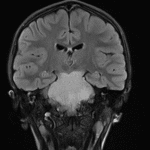 Homogeneous FLAIR hyperintense mass involving the entire pons and extending into the midbrain and medulla, which is a classic imaging appearance for a diffuse midline glioma.