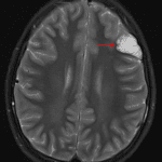 Wedge-shaped, cortically-based, bubbly T2 hyperintense lesion in the left frontal lobe (red arrow) consistent with a DNET.