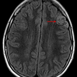 Note the heterogeneous internal FLAIR signal with a preserved hyperintense rim (red arrow).