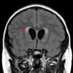 Associated obstructive hydrocephalus with subependymal edema (red arrows).